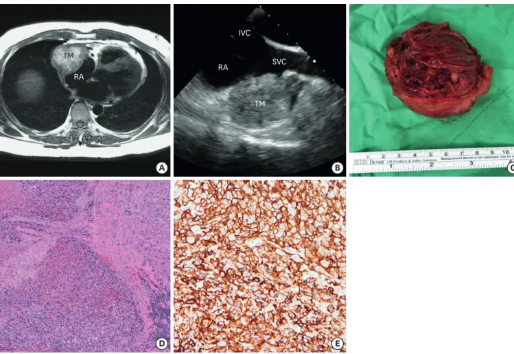 Figure 1. Primary pericardial angiosarcoma. (A) CMR image revealed a huge hyperintense T1-weighted mass at pericardial space with right atrial compression