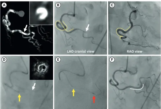 Figure 2. Computed tomographic, angiographic, and intravascular ultrasound images of rotational atherectomy using a 5Fr child guide catheter (“mother-and- (“mother-and-child” technique)