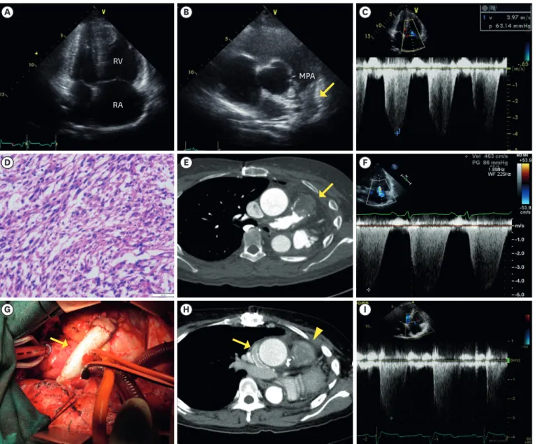 Figure 1. Various images obtained during long-term treatment. (A) Markedly enlarged right atrium and ventricle were observed on TTE
