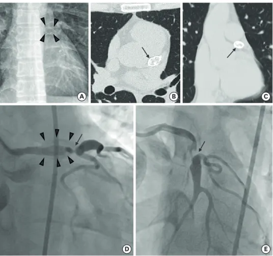 Figure 1. An ovoid mass near left side of the aorta in chest X-ray (arrow heads) (A). A condensed calcified  mass located on LMCA (arrow) in horizontal section (B) and coronal section (C) of chest CT