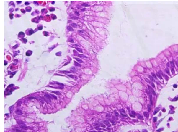 Fig. 1.  H. pylori stained with pink color by H&amp;E stain in  surface epithelium of gastric mucosa and they are difficult to  detect with the H&amp;E stain