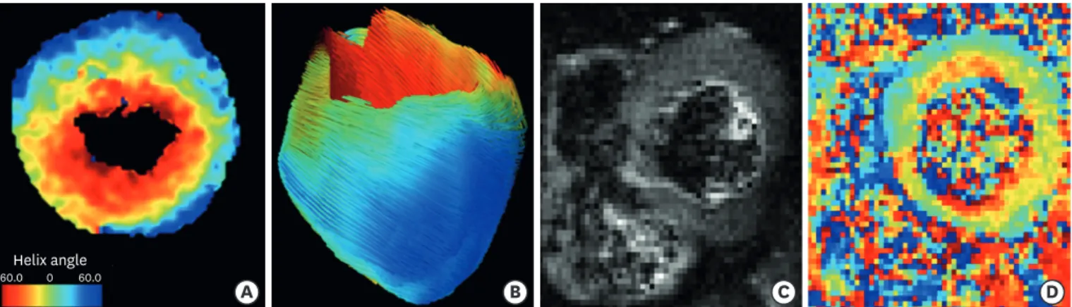 Figure 1. Representative image of diffusion tensor imaging (A) short-axis view of helix angle map and (B) tractography of the heart of a healthy mice, (C) diffusion  image (left) and (D) corresponding helix angle map (right) of a patient with hypertrophic 