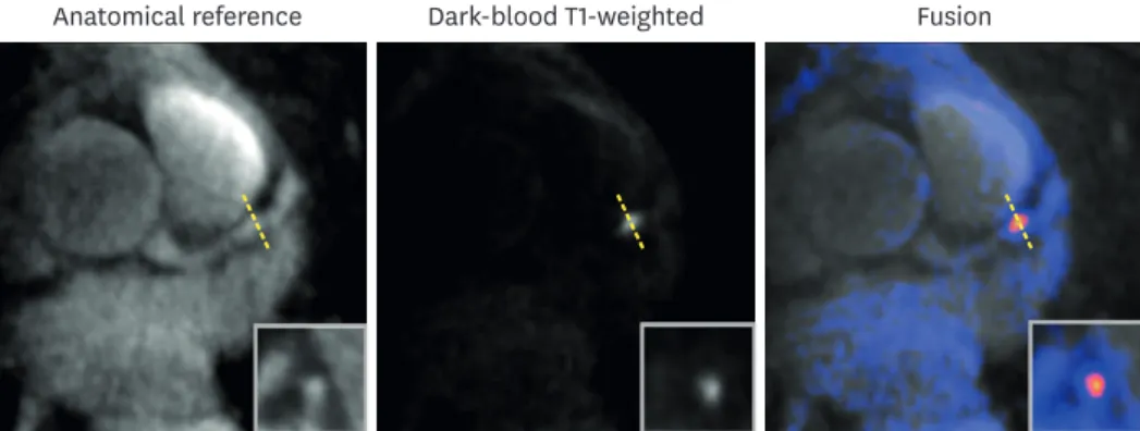 Figure 3. Representative image of pre-contrast coronary atherosclerosis T1-weighted characterization with  integrated anatomical reference in a patient with a coronary hyperintensive plaque in the mid left anterior  descending artery.