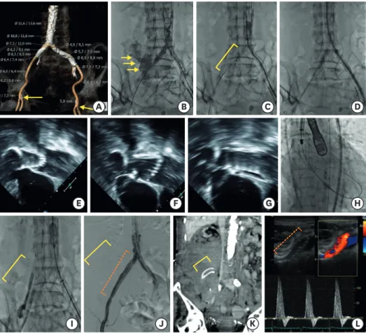 Figure 1. Computed tomographic, fluoroscopic, and echocardiographic images. (A) Severe calcification from the  iliac arteries to the descending aorta on computed tomography (CT)