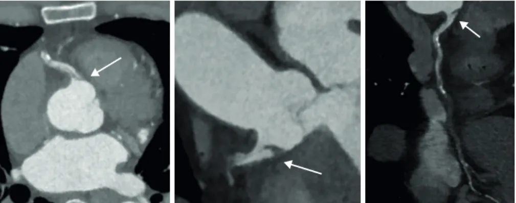 Figure 2. Cardiac computerized tomogram. A flap formed by the right coronary artery dissection was identified at  the ostium (arrow)