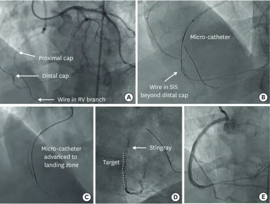 Figure 2. Example of ADR as a bailout for sub-intimal wire passage in contemporary practice