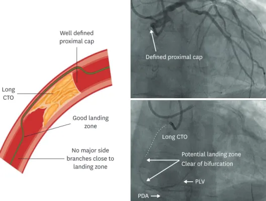 Figure 3. Ideal anatomy for a primary ADR procedure using the CrossBoss and Stingray system 