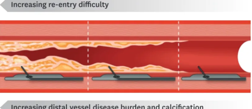 Figure 7. Examples of different disease burdens at the landing zone. The most rightward example is often  amenable to re-entry with the Stingray wire, whereas many experienced operators are now using high penetration  force wires for the scenario on the le