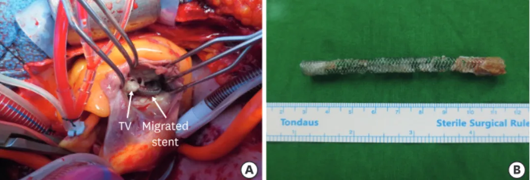 Figure 2. (A) The right atrium was opened, and the stent was attached with TV in the right ventricle