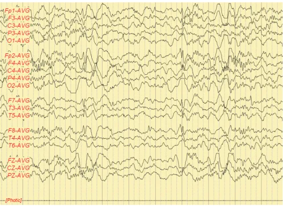 Fig. 2. Occasional spike or sharp wave discharges from both frontal and temporal area (Patient A).