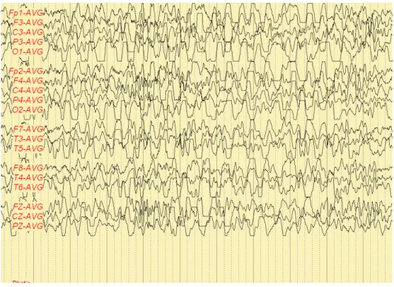 Fig. 3. Frequent synchronous or independent spike discharges from Fp1 and Fp2 (Patient B)