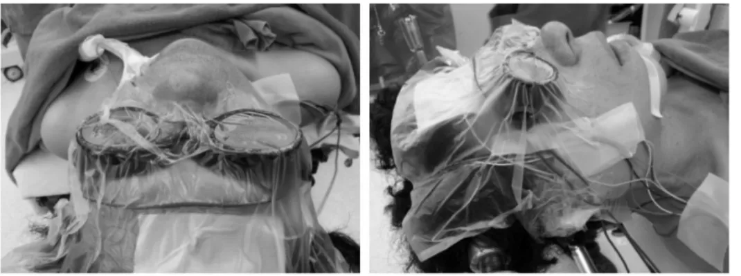 Table  2.  Intraoperative  VEP  wave  changes  the  impact  of  the  patient’s  vision  after  surgery