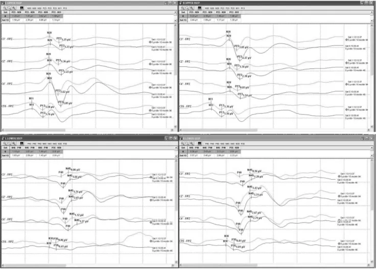 Fig.  10.  Example  of  SEP  recordings.