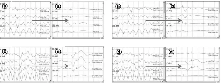 Fig.  11.  Priming  pulses  test  of  MEP.  t,  pulse  duration  –  fixed  at 50  μs;  i,  interpulse  interval  (pulse  rate).