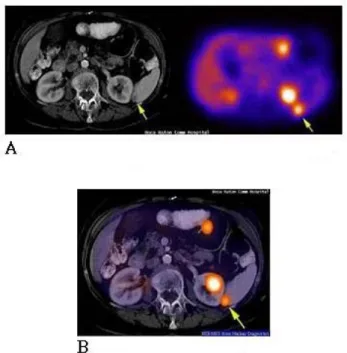 Fig. 4. The PET/CT fusion image (A) CT data (left) and PET  data (right), (B) PET/CT fusion image.