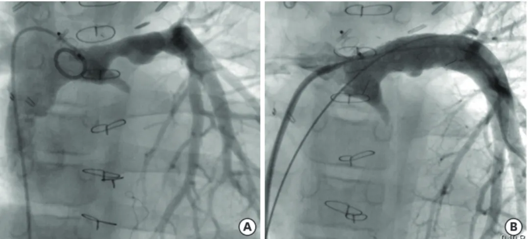 Figure 1. (A) Catheterization after Fontan operation demonstrated multiple narrowings of the LPA