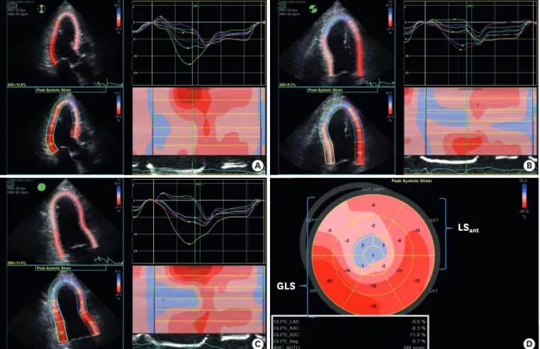 Figure 2. Measurement of GLS and LS ant  using two-dimensional speckle tracking echocardiography