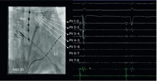Figure 2. LSPV occlusion with 28 mm cryoballoon and real time visualization of electrical PV isolation