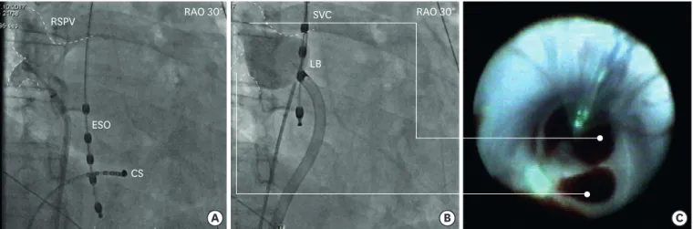 Figure 3. (A) Baseline PV angiogram of RSPV before laser PVI showing 2 RSPV branches and catheter settings