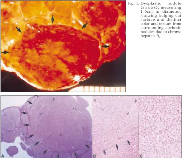 Fig. 2. Dysplastic  nodule,  low  grade  in  a  liver  with  cirrhosis  due  to  chronic  hepatitis  C