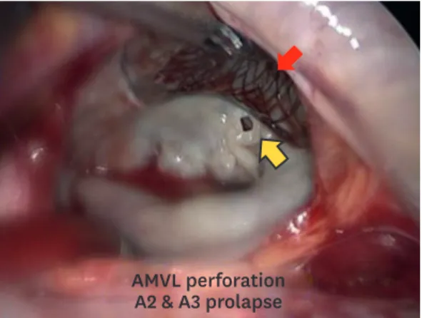 Figure 2. Mitral valve: anterior mitral leaflet perforation (about 3 mm) with diffuse anterior leaflet prolapsed