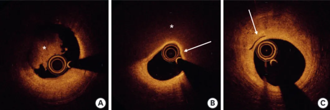 Figure 2. Typical OCT findings representing vulnerable plaques. (A) shows intraluminal thrombus characterized by a mass ( * ) attached to the wall (9–12  o'clock)