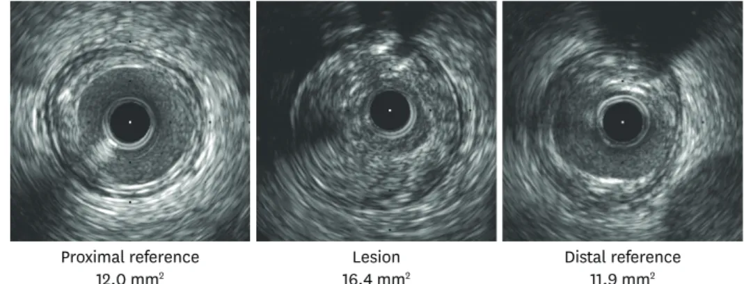 Figure 5. Positive remodeling. EEM area can be measured with IVUS. RI is calculated as the ratio of lesion EEM area divided by that of reference site