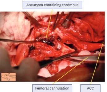 Figure 2. Surgical finding. Image taken during surgery revealing the giant aortic aneurysm containing a red thrombus