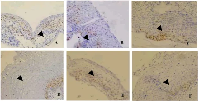Fig. 2. Immunohistochemical stainings  for p53 expression in cervical dysplasia(A, B, C) and HPV-infected  dysplasia (D, E, F) (x 100)
