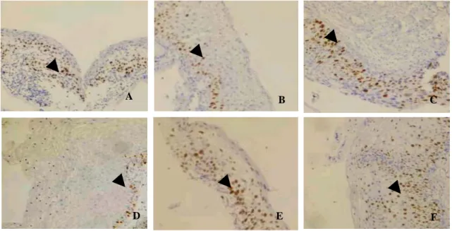 Fig. 3. Immunohistochemical stainings for Ki-67 expression  in cervical dysplasia(A, B, C) and HPV-infected  dysplasia (D, E, F) (x 100),  A; mild dysplasia,  B; moderate dysplasia, C; severe dysplasia, D; mild dysplasia with HPV, E; moderate dysplasia wit