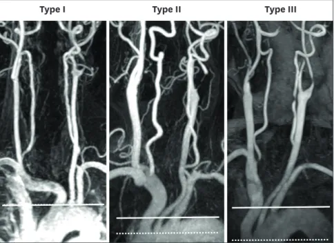 Figure 1. Types I, II, and III aortic arches on magnetic resonance angiograms of 3 patients with symptomatic significant left proximal internal carotid artery  stenosis