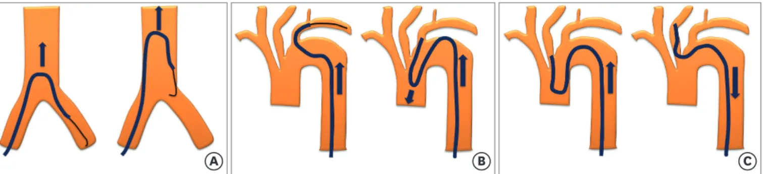 Figure 2. Engagement methods with the Simmons catheter. (A) If the Simmons catheter is inserted into the opposite iliac artery and then pushed toward the  abdominal aorta, an inverted U-shaped curve of the catheter can be made