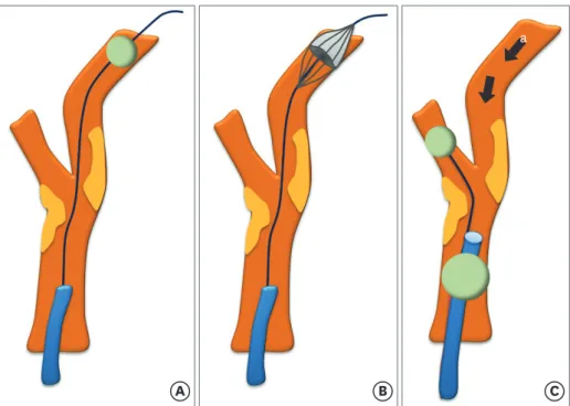 Figure 3. Schematic illustration of EPDs. (A) Distal balloon occlusion device, (B) distal filter protection device, (C) proximal protection device