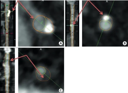 Figure 1. CCTA based plaque characteristics associated with high-risk plaque on multiplanar reconstruction  and corresponding and short-axis en face axial view