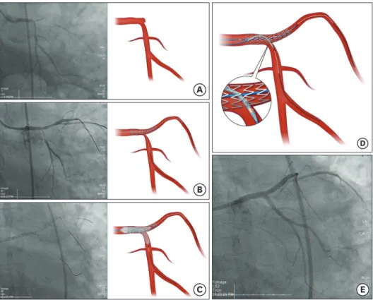 Figure 1. Procedural findings. (A) Pre-PCI CAG. (B) After deployment of a stent into the LAD, the LCX ostium was  compromised