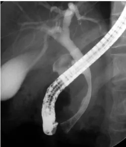 Fig.  3.  A  metal  stent  is  inserted  to  the  distal  bile  duct  to  relieve  obstructive  jaundice  in  a  patient  with  pancreas  head  cancer.