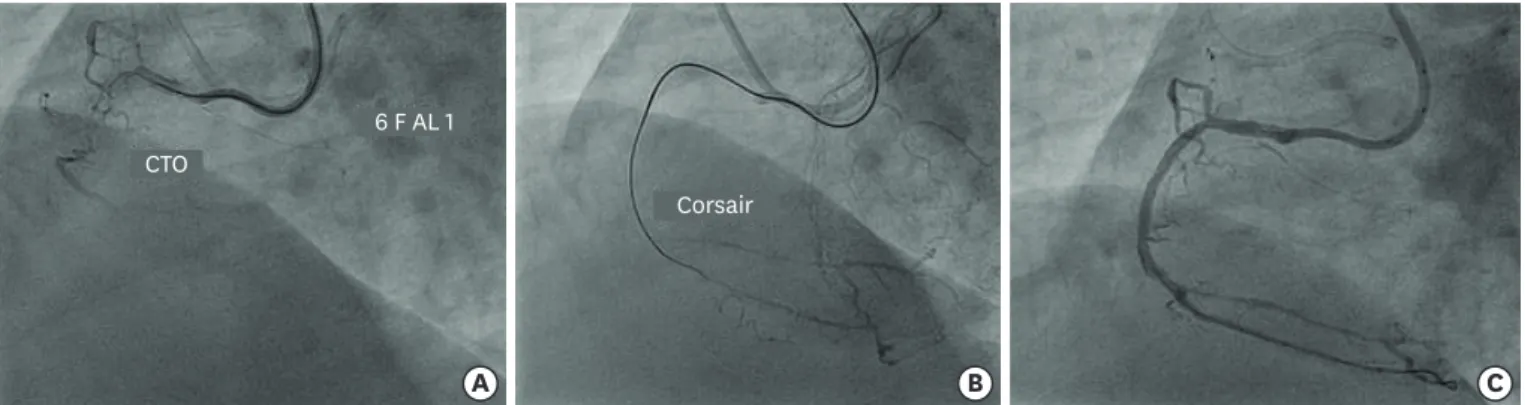 Figure 6. (A) Engagement of RCA ostium with 6 F AL 1guide catheter to address CTO of proximal segment with bridging collateral