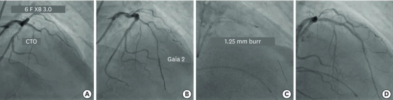 Figure 7. (A) Engagement of LMCA ostium with 6 F XB 3.0 guide catheter to fix long mid segment CTO of LAD