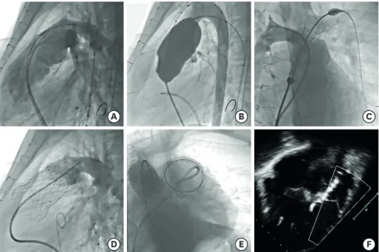 Figure 3. Series of images demonstrating transcatheter pulmonary valve replacement with Venus P valve in  a patient with a previous transannular patch