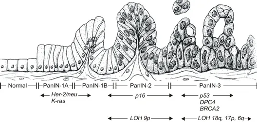Fig.  4.  Genetic  progression  in  the  pancreatic  ducts  (Hruban  RH,  et  al.  2001).