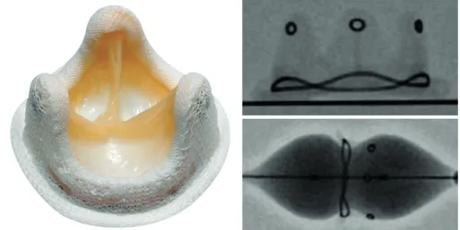 Figure 1. Hancock II bioprosthetic mitral valve and its fluoroscopic image.