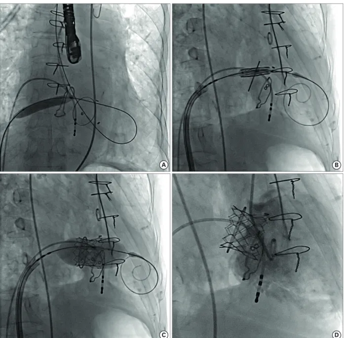Figure 2. (A) Balloon atrial septostomy with 10×40mm balloon. (B) Positioning of Edwards SAPIEN 3 valve within surgical bioprosthesis over a Safari wire