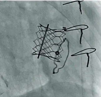 Figure 3. The final fluoroscopic image of mitral valve after the procedure.
