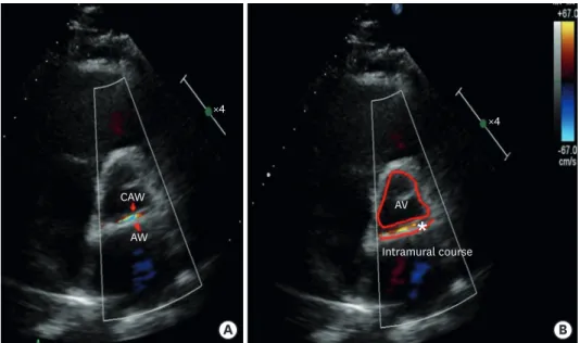 Figure 3. Transthoracic echocardiogram in parasternal short axis view shows an intramural decourse (asterisk)  of the of the proximal portion of RCA (A, B: the red conturns highlight the borders of the aortic annulus and the  intramural wall of the vessel)