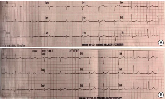 Figure 6. Electrocardiogram (A) pre- and (B) post-successful stenting of the intramural course demonstrating  resolution of the ST changes in inferior leads, in particular D3.