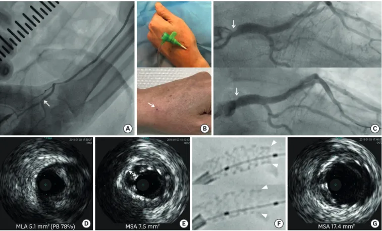 Figure 1. (A) Peripheral angiography of left hand demonstrating relevant caliber of distal radial artery compared with conventional puncture site of radial artery  (arrow, punctured artery site of left snuffbox approach)