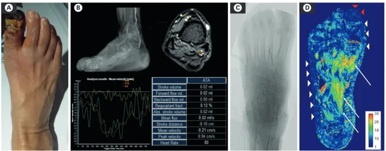 Figure 1. (A) Clinical photograph shows dry gangrene at the distal half of the toe. (B) Preprocedural time-of-flight magnetic resonance angiography image  showing absent anterior tibial artery (ATA) flow
