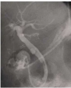 Fig.  4.  Postoperative  cholangiography  shows  no residual  cystic  duct  and  stone  in  the  common  bile duct