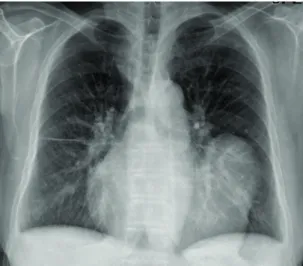 Figure 1. Preoperative chest X-ray shows a soft tissue density measuring 7×5 cm merging with the left heart border.