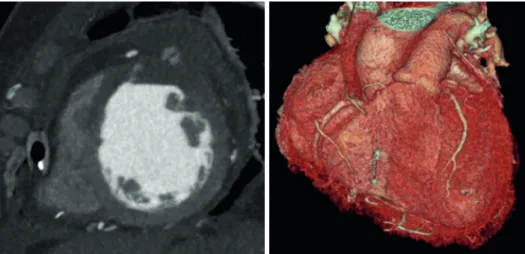 Figure 5. Postoperative CT scan shows a successful reconstruction of the LV. 